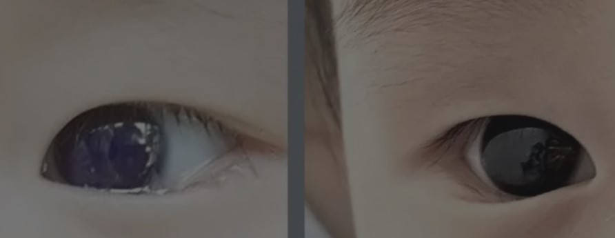 Una medicina para el Covid-19 le cambió el color de los ojos a un bebé