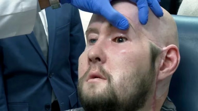 Realizan por primera vez en la historia médica un trasplante de ojo humano completo